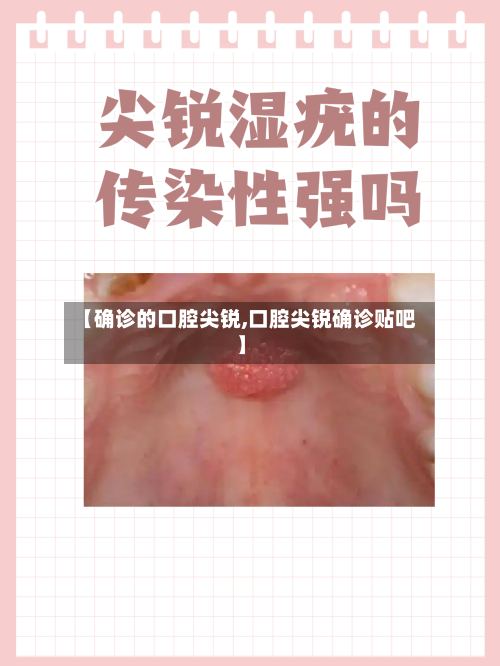 【确诊的口腔尖锐,口腔尖锐确诊贴吧】