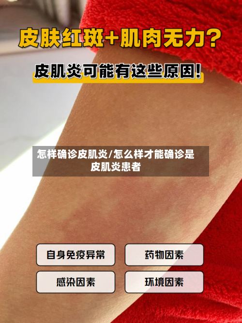 怎样确诊皮肌炎/怎么样才能确诊是皮肌炎患者