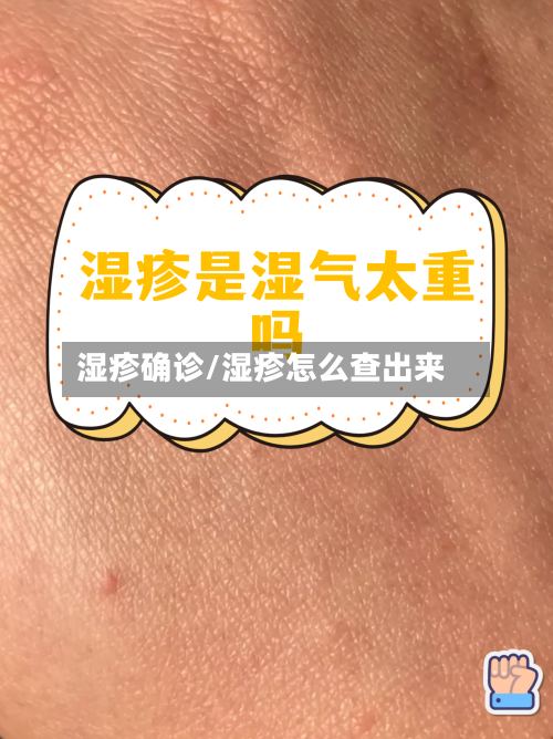 湿疹确诊/湿疹怎么查出来