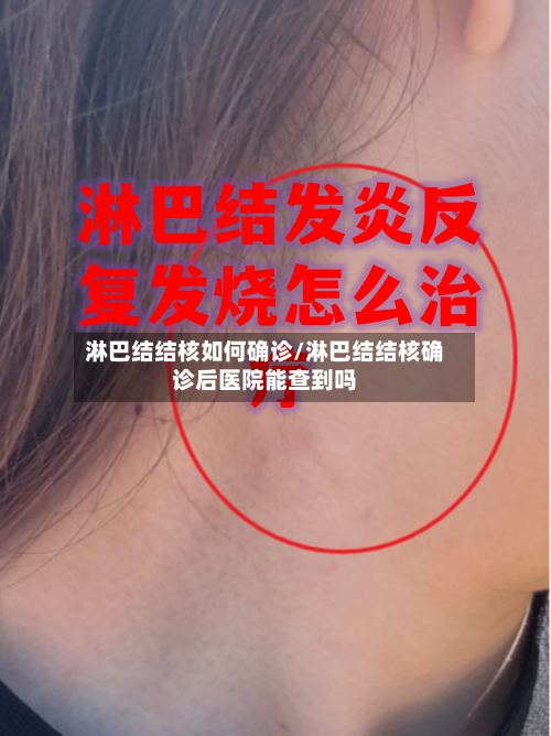淋巴结结核如何确诊/淋巴结结核确诊后医院能查到吗-第2张图片