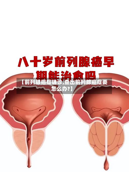 【前列腺癌症确诊,查出前列腺癌症要怎么办?】