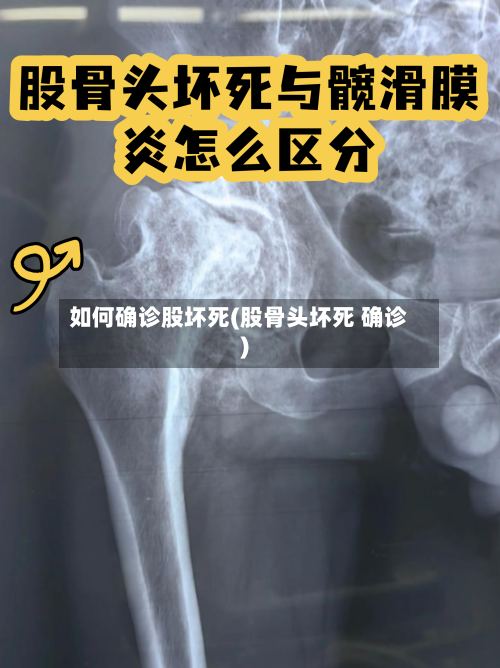 如何确诊股坏死(股骨头坏死 确诊)-第2张图片