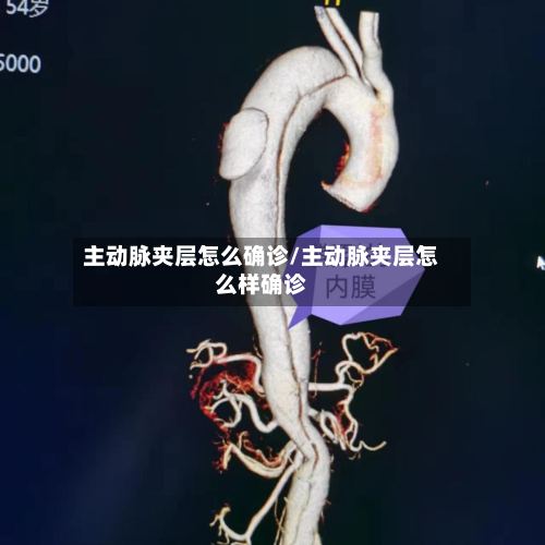 主动脉夹层怎么确诊/主动脉夹层怎么样确诊