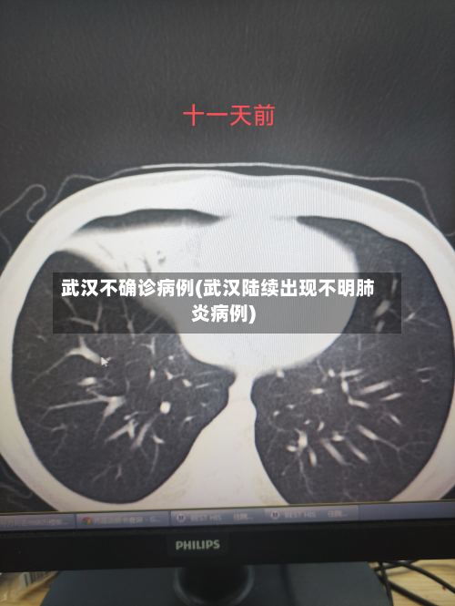 武汉不确诊病例(武汉陆续出现不明肺炎病例)