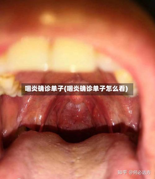 咽炎确诊单子(咽炎确诊单子怎么看)