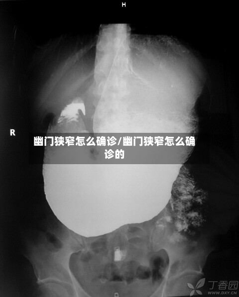 幽门狭窄怎么确诊/幽门狭窄怎么确诊的