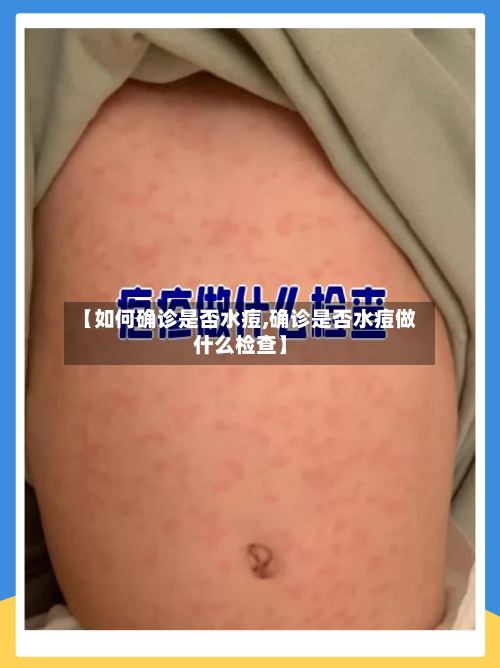 【如何确诊是否水痘,确诊是否水痘做什么检查】