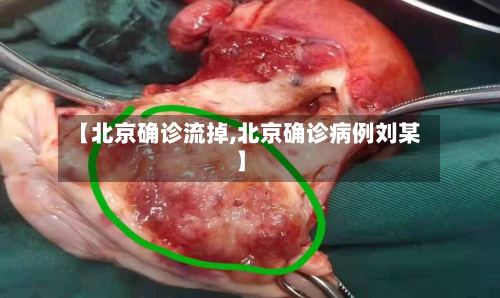 【北京确诊流掉,北京确诊病例刘某】