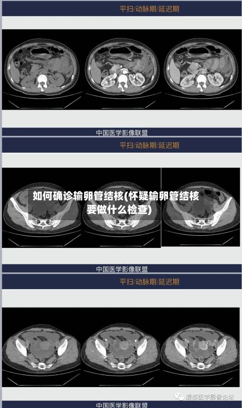 如何确诊输卵管结核(怀疑输卵管结核要做什么检查)