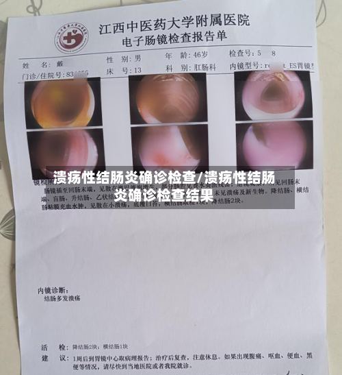 溃疡性结肠炎确诊检查/溃疡性结肠炎确诊检查结果