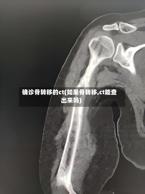 确诊骨转移的ct(如果骨转移,ct能查出来吗)
